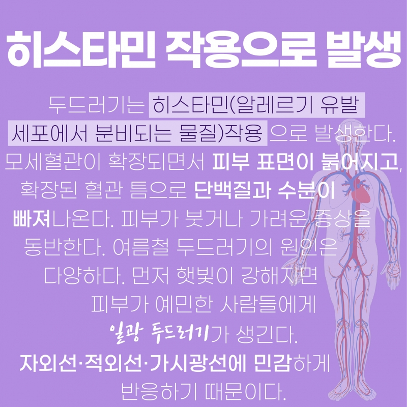 원인 모르는 여름철 가려움증에 대해 알아보자!