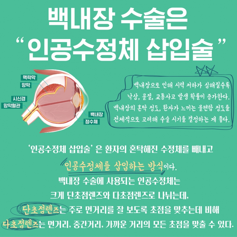 [HEALTH] 백내장 오면 수술부터 해야한다? 일상 큰 불편 없으면 관리부터 하세요!